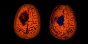 Image of my brain before (left) and after (right) Comparing imaging before / after for my brain