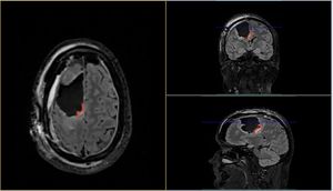 Gary after the operation highlighted in red. MRI scan of Gary after the operation.