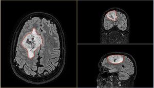 Gary before the operation highlighted in red. MRI scan of Gary before the operation.